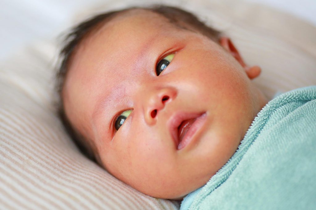 تشخیص و درمان بیلی زردی در نوزادان
